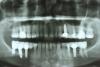 Ортопантомограф Siemens Orthopantomograph 10E